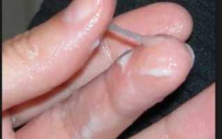 Виды и причины неприятных выделений при молочнице