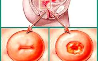 Аборт при эрозии шейки матки: есть ли риск развития осложнений?