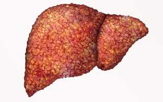 Хронический алкоголизм — стадии, симптомы, способы лечения заболевания