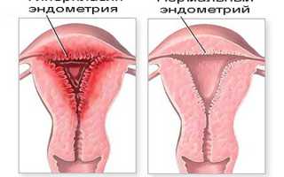 Почему развивается толстый эндометрий?