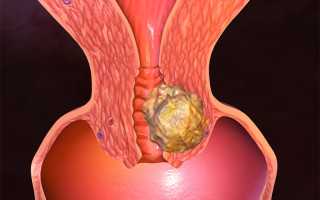 Карциносаркома матки: лечение онкологического процесса и прогноз