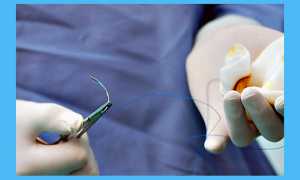 Спайки после кесарева: симптомы, лечение и профилактика