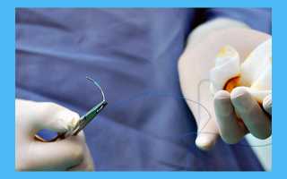 Спайки после кесарева: симптомы, лечение и профилактика