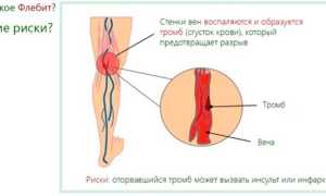 Флебит — причины, симптомы и лечение