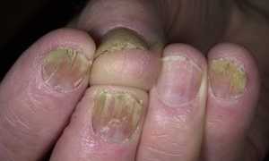 Лечение грибковой инфекции на ногтях при помощи яблочного уксуса
