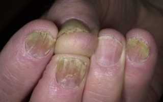 Лечение грибковой инфекции на ногтях при помощи яблочного уксуса
