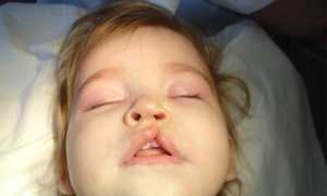 Волчья пасть