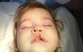 Волчья пасть