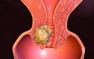 Чем отличается рабдомиома матки от других?