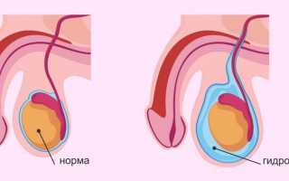 Водянка яичка (гидроцеле): симптомы, диагностика, лечение