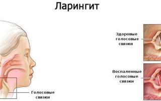 Лечение ларингита у детей и взрослых в домашних условиях