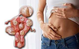 Растет ли живот при миоме матки и как быстро?