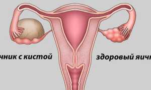 Признаки кисты яичника