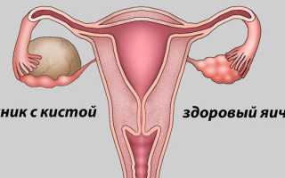 Признаки кисты яичника