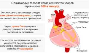Синусовая тахикардия сердца у ребенка или взрослого