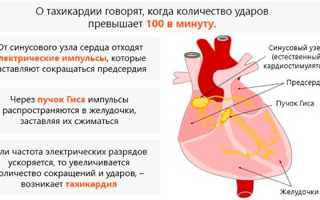 Синусовая тахикардия сердца у ребенка или взрослого