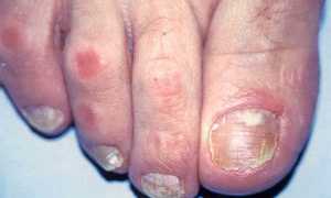 Действенные методы лечения грибка уксусом в домашних условиях