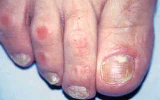 Действенные методы лечения грибка уксусом в домашних условиях