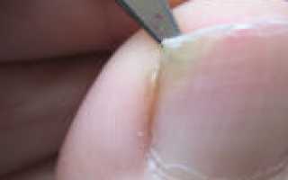 Распространенная патология — кандидозный грибок ногтей