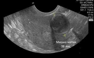 Размеры миомы матки по неделям и в сантиметрах: как определить риски