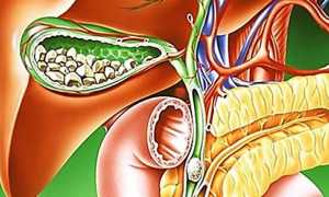 Острый калькулезный холецистит