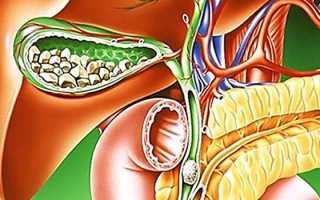 Острый калькулезный холецистит
