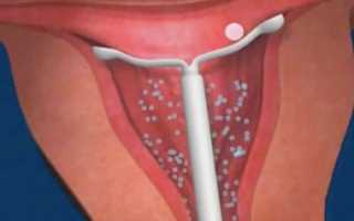 Внутриматочная спираль при загибе матки