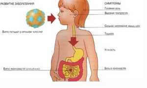 Желудочный грипп — симптомы и лечение у детей или взрослых