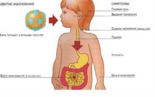 Желудочный грипп — симптомы и лечение у детей или взрослых