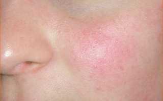 Появление красных пятен на лице при беременности