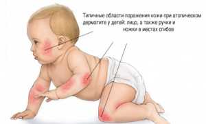 Атопический дерматит новорожденных