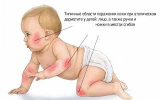 Атопический дерматит новорожденных