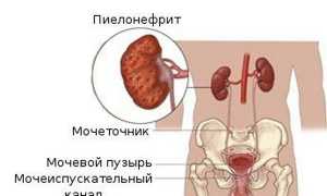 Гестационный пиелонефрит при беременности