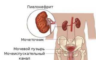 Гестационный пиелонефрит при беременности