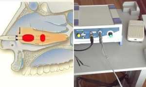 Вазотомия носовых раковин — методы проведения операции