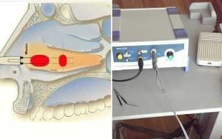 Вазотомия носовых раковин — методы проведения операции
