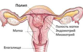 Можно ли забеременеть с полипом в матке: вероятность,  в чем трудности?