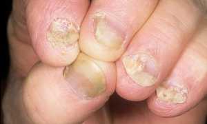 Причины, симптомы и эффективное лечение грибка ногтей