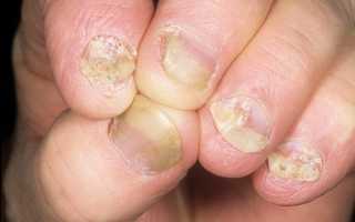 Причины, симптомы и эффективное лечение грибка ногтей