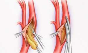 Артериальный тромбоз – лечение медикаментозными препаратами и хирургическим путем