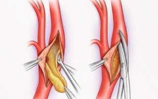 Артериальный тромбоз – лечение медикаментозными препаратами и хирургическим путем