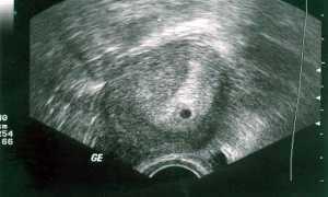 УЗИ на раннем сроке беременности