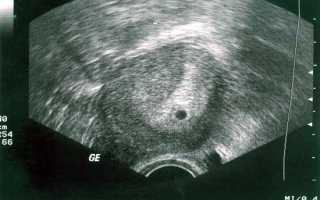 УЗИ на раннем сроке беременности