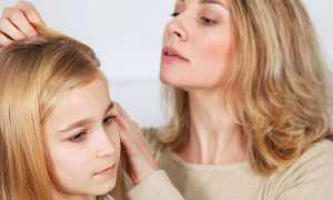 Гниды на волосах у человека