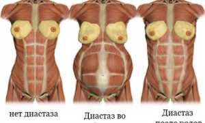 Что представляет собой диастаз после родов, лечим расхождение прямых мышц живота
