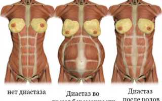 Что представляет собой диастаз после родов, лечим расхождение прямых мышц живота