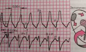 Пароксизмальная аритмия: симптомы, диагностика и лечение