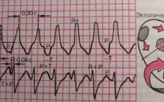 Пароксизмальная аритмия: симптомы, диагностика и лечение