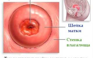 Особенности небольшой эрозии шейки матки