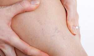 Что делать, если отекают ноги после родов, как решить проблему